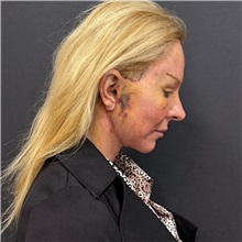 Facelift After Photo by Cem Berkay SINACI, MD; Istanbul, M - Case 51597