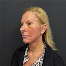 Facelift After Photo by Cem Berkay SINACI, MD; Istanbul, M - Case 51597