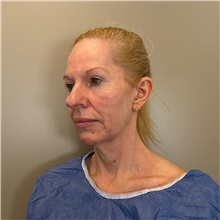 Facelift Before Photo by Cem Berkay SINACI, MD; Istanbul, M - Case 51597