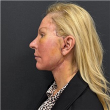 Facelift After Photo by Cem Berkay SINACI, MD; Istanbul, M - Case 51597