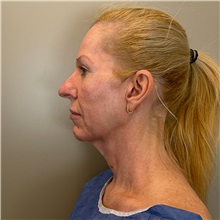 Facelift Before Photo by Cem Berkay SINACI, MD; Istanbul, M - Case 51597