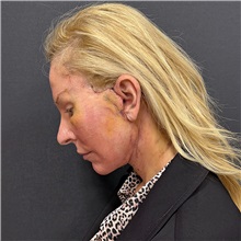 Facelift After Photo by Cem Berkay SINACI, MD; Istanbul, M - Case 51597