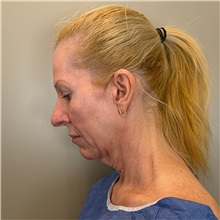 Facelift Before Photo by Cem Berkay SINACI, MD; Istanbul, M - Case 51597