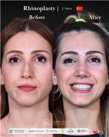Rhinoplasty After Photo by Caner Kacmaz, MD; Istanbul, M - Case 51465