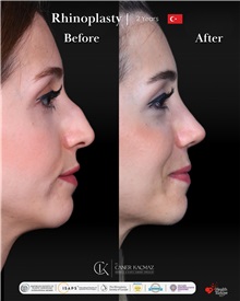 Rhinoplasty Before Photo by Caner Kacmaz, MD; Istanbul, M - Case 51465