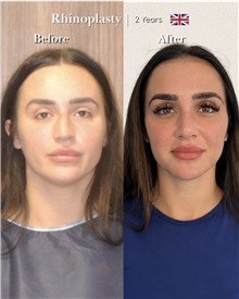 Rhinoplasty After Photo by Caner Kacmaz, MD; Istanbul, M - Case 51476
