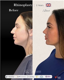 Rhinoplasty Before Photo by Caner Kacmaz, MD; Istanbul, M - Case 51476