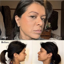 Facelift After Photo by Caner Kacmaz, MD; Istanbul, M - Case 51477