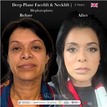 Facelift Before Photo by Caner Kacmaz, MD; Istanbul, M - Case 51477