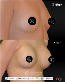 Breast Augmentation After Photo by Caner Kacmaz, MD; Istanbul, M - Case 51478