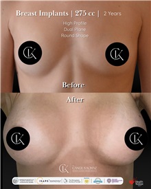 Breast Augmentation Before Photo by Caner Kacmaz, MD; Istanbul, M - Case 51478