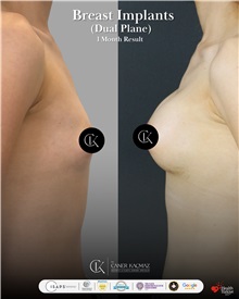 Breast Augmentation After Photo by Caner Kacmaz, MD; Istanbul, M - Case 51480