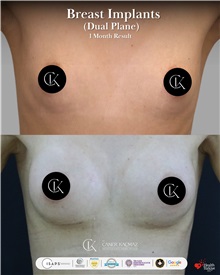 Breast Augmentation Before Photo by Caner Kacmaz, MD; Istanbul, M - Case 51480