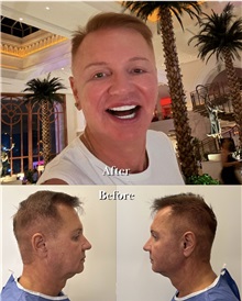 Facelift After Photo by Caner Kacmaz, MD; Istanbul, M - Case 51481