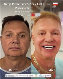 Facelift Before Photo by Caner Kacmaz, MD; Istanbul, M - Case 51481