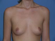 Breast Augmentation Before Photo by Steve Sample, MD, FACS; Arlington Heights, IL - Case 23306