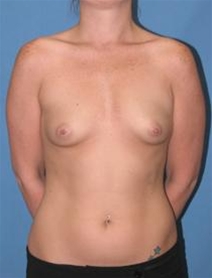 Breast Augmentation Before Photo by Steve Sample, MD; Arlington Heights, IL - Case 23307