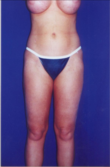 Buttock Implants After Photo by Steve Sample, MD, FACS; Arlington Heights, IL - Case 24131