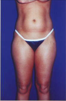 Buttock Implants Before Photo by Steve Sample, MD; Arlington Heights, IL - Case 24131