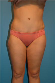 Tummy Tuck After Photo by Steve Sample, MD; Arlington Heights, IL - Case 24141