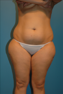 Tummy Tuck Before Photo by Steve Sample, MD, FACS; Arlington Heights, IL - Case 24141
