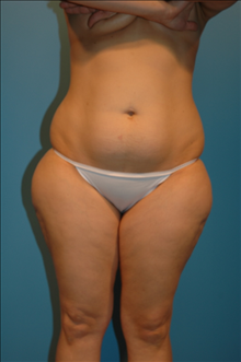 Tummy Tuck Before Photo by Steve Sample, MD; Arlington Heights, IL - Case 24141