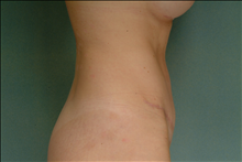 Tummy Tuck After Photo by Steve Sample, MD; Arlington Heights, IL - Case 24142