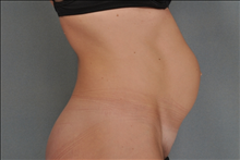 Tummy Tuck Before Photo by Steve Sample, MD; Arlington Heights, IL - Case 24142