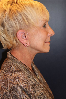 Facelift After Photo by Larry Weinstein, MD; Chester, NJ - Case 25080