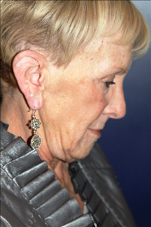 Facelift Before Photo by Larry Weinstein, MD; Chester, NJ - Case 25080