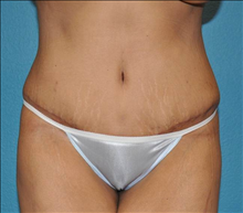 Liposuction After Photo by Steve Sample, MD, FACS; Arlington Heights, IL - Case 25486
