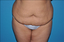 Liposuction Before Photo by Steve Sample, MD, FACS; Arlington Heights, IL - Case 25486