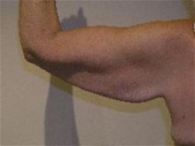 Arm Lift Before Photo by Steve Sample, MD; Arlington Heights, IL - Case 25727