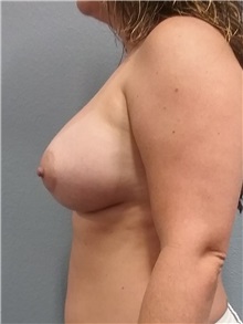 Breast Augmentation After Photo by Jacob Gerzenshtein, MD; Lakeland, FL - Case 29889