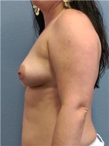 Breast Augmentation Before Photo by Jacob Gerzenshtein, MD; Lakeland, FL - Case 29889