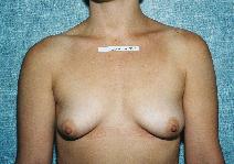 Breast Augmentation Before Photo by Peter Pacik, MD; Manchester, NH - Case 2278