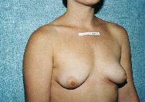 Breast Augmentation Before Photo by Peter Pacik, MD; Manchester, NH - Case 2278