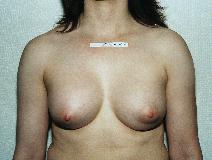 Breast Augmentation After Photo by Peter Pacik, MD; Manchester, NH - Case 2336