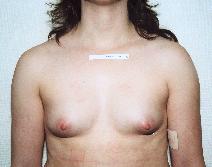 Breast Augmentation Before Photo by Peter Pacik, MD; Manchester, NH - Case 2336