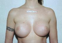 Breast Augmentation After Photo by Peter Pacik, MD; Manchester, NH - Case 2614