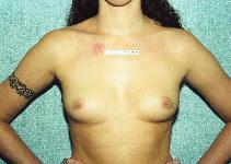 Breast Augmentation Before Photo by Peter Pacik, MD; Manchester, NH - Case 2614