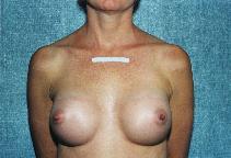 Breast Augmentation After Photo by Peter Pacik, MD; Manchester, NH - Case 2917