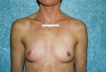 Breast Augmentation Before Photo by Peter Pacik, MD; Manchester, NH - Case 2917