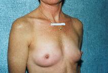 Breast Augmentation Before Photo by Peter Pacik, MD; Manchester, NH - Case 2917