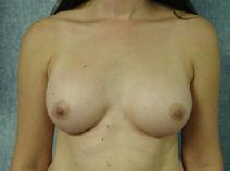 Breast Augmentation After Photo by Peter Pacik, MD; Manchester, NH - Case 3104