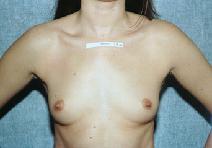 Breast Augmentation Before Photo by Peter Pacik, MD; Manchester, NH - Case 3104