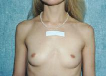 Breast Augmentation Before Photo by Peter Pacik, MD; Manchester, NH - Case 3123