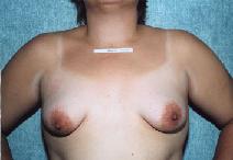 Breast Augmentation Before Photo by Peter Pacik, MD; Manchester, NH - Case 3158
