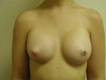 Breast Augmentation After Photo by Peter Pacik, MD; Manchester, NH - Case 3267