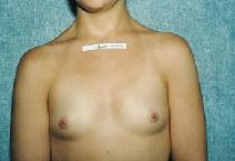 Breast Augmentation Before Photo by Peter Pacik, MD; Manchester, NH - Case 3267